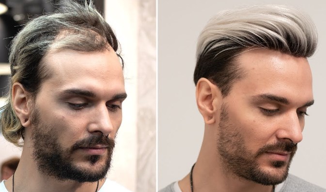 sistema de cabello para hombre