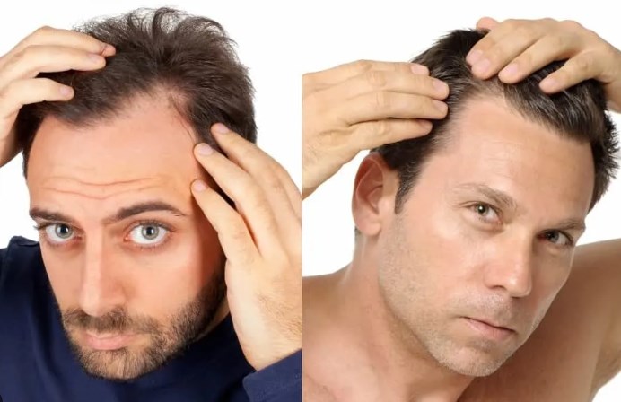 Moget vs. vikande hårfäste