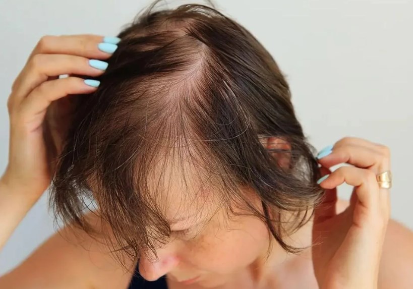 Hair Loss After Surgery How to Stop or Prevent It? Hair System