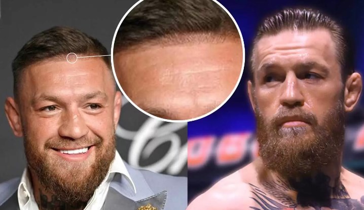 Everything About Conor Mcgregor Hair Transplant - Hair System