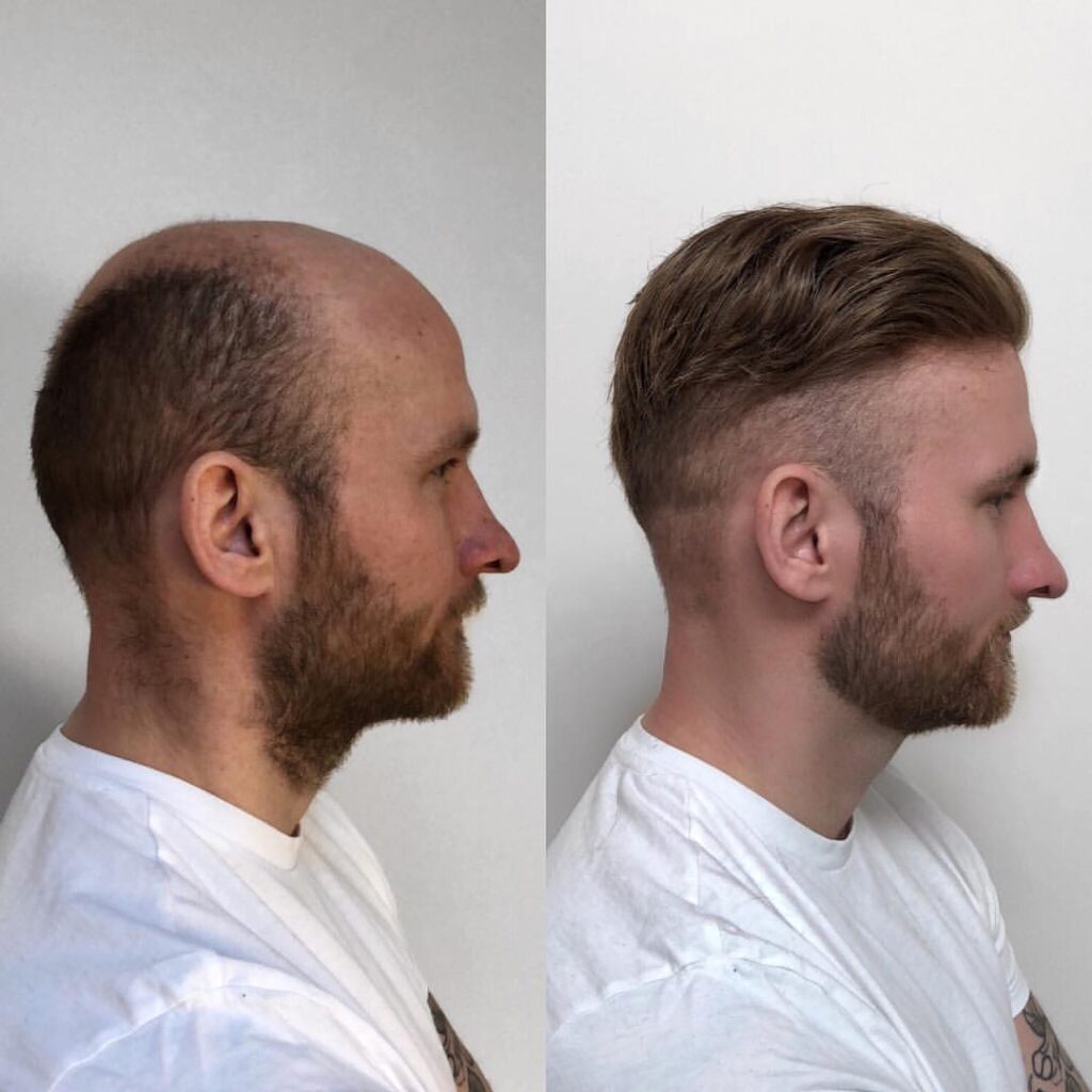 Side-by-side view of a man before and after fitting a ReHair hair system